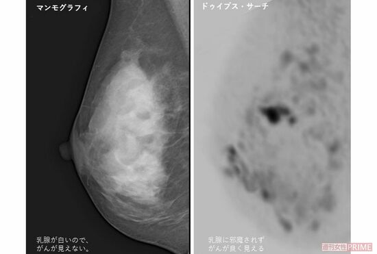 乳がん検査はもう 痛くない 最新の無痛検診を段取りから費用まで詳細レポート 週刊女性prime