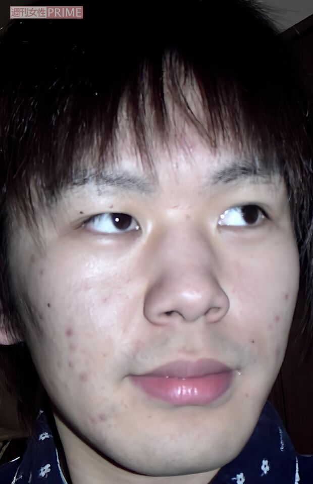 ニキビにも悩まされていた（藤本スバルさん提供写真）