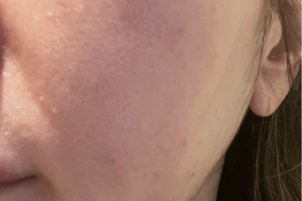 稗粒腫施術5日目