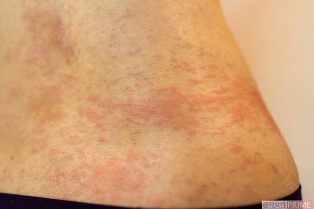 湿疹が出た女性の腰の部分。多くの水分を吸収・放出することで乾燥肌が悪化してしまうパターンも