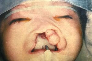 口唇口蓋裂は胎生期の組織欠損または癒合不全により、先天的に口唇（唇）、口蓋（口の中の天井）、上顎（歯ぐき）に裂を認める病態