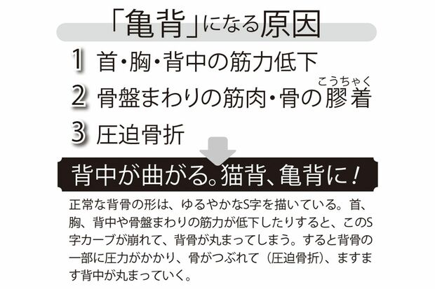 「亀背」になる原因