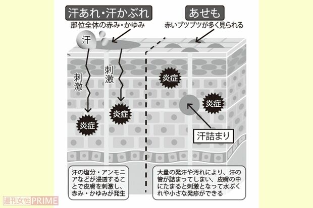 「汗あれ・汗かぶれ」と「あせも」のメカニズム