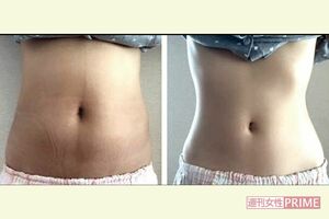 先生の患者さんが3か月間続けた結果、お腹の脂肪がスッキリ!