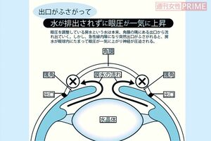 緑内障 イラスト/松田弘美