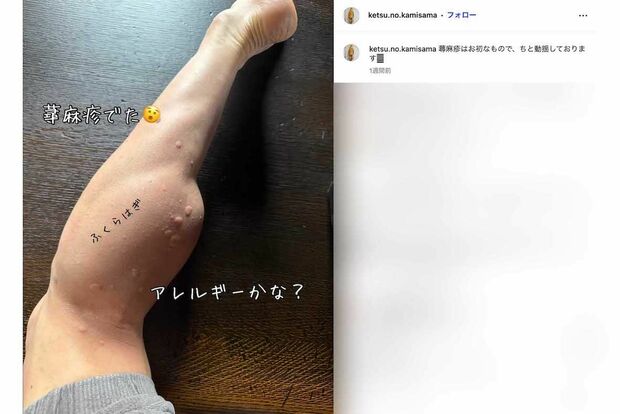 《蕁麻疹でた》と症状をアップしたゴールデンボンバーの樽美酒研二（本人のインスタグラムより）