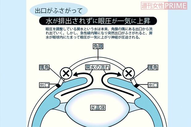 緑内障　　イラスト／松田弘美