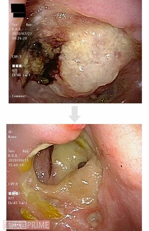 【症例2:80代女性上顎歯肉がん】内視鏡で見たBNCT治療前後の様子。左上の白い腫瘍部分がキレイに!