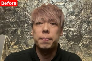 【Before】普段はウィッグをかぶって生活。一重で目つきが悪いのが気になっていた。鼻も上向きで鼻の穴が見えやすいことに加えて小鼻も広がりぎみ。顎の広がりもなんとかしたい。